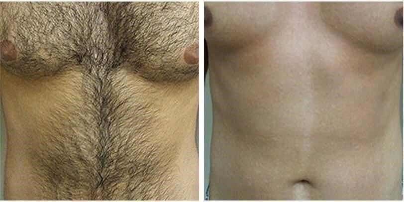 Attrezzature mediche: Diodenlaser 808nm – Nuovo (secondo la descrizione) da Boningen venduto da Beauty_Power_GmbH 3