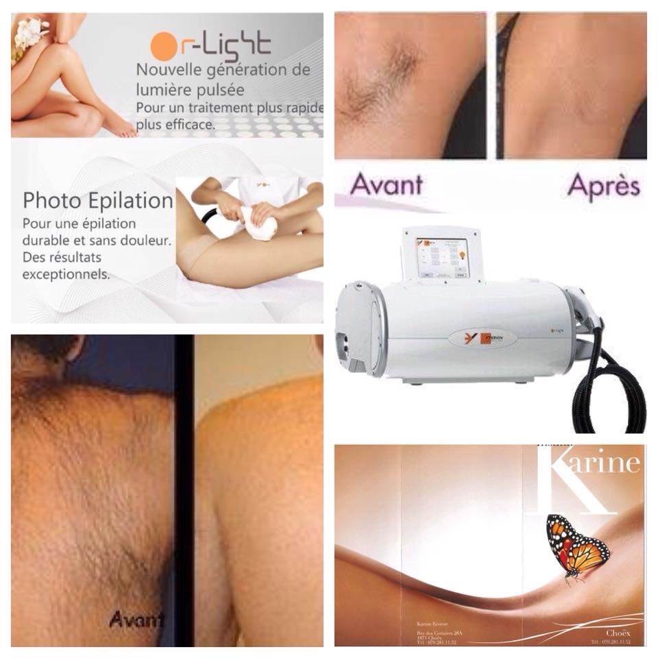 Epilatori: YPERION Or-Light Système IPL – Usato da Choëx venduto da Doudoune1 4