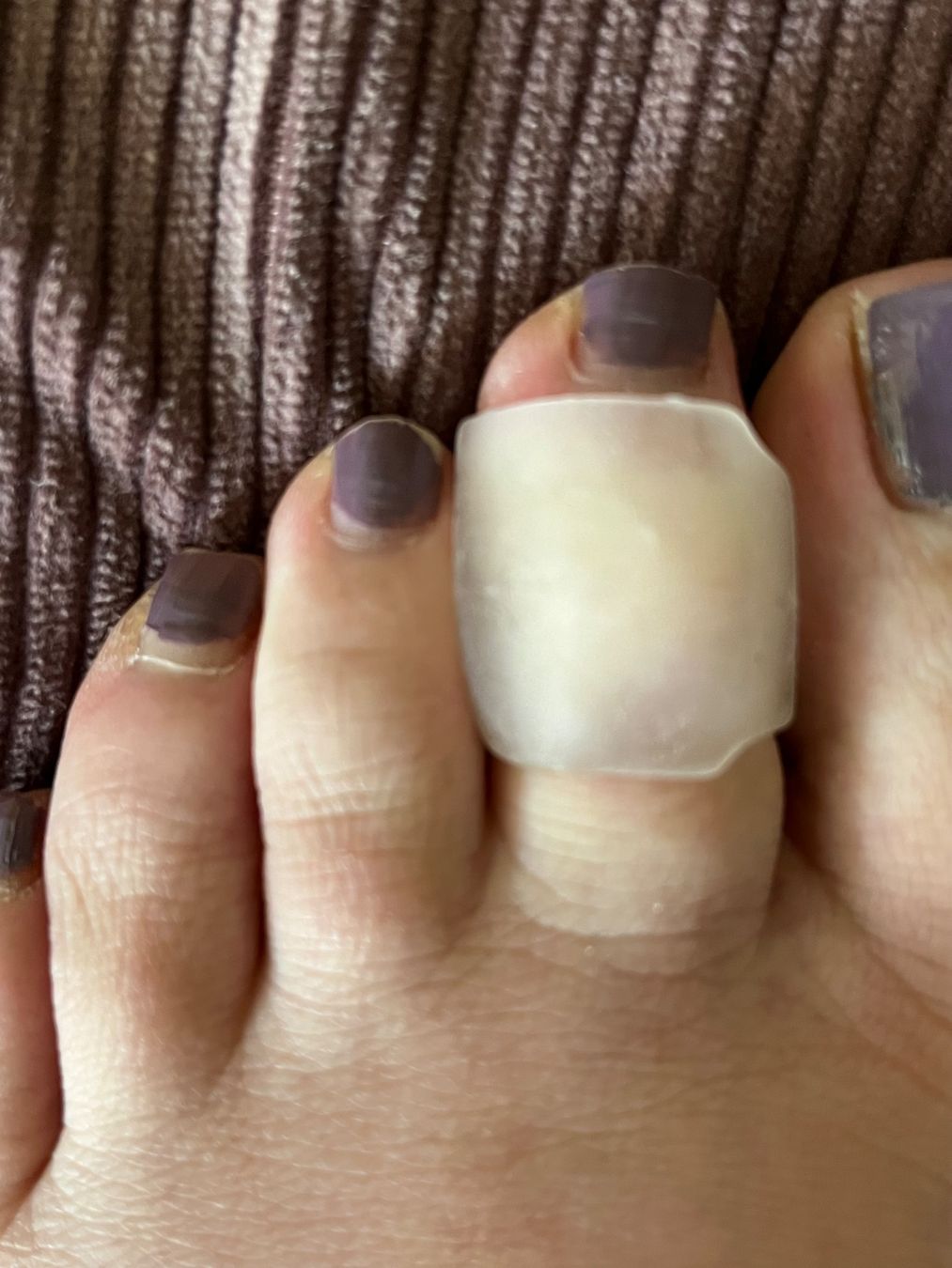 Pedicure: Zehen Korrekturring G – Nuovo e nell'imballaggio originale da Nottwil venduto da Frontal 4