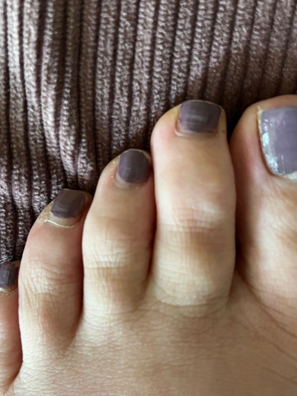 Pedicure: Zehen Korrekturring G – Nuovo e nell'imballaggio originale da Nottwil venduto da Frontal 3