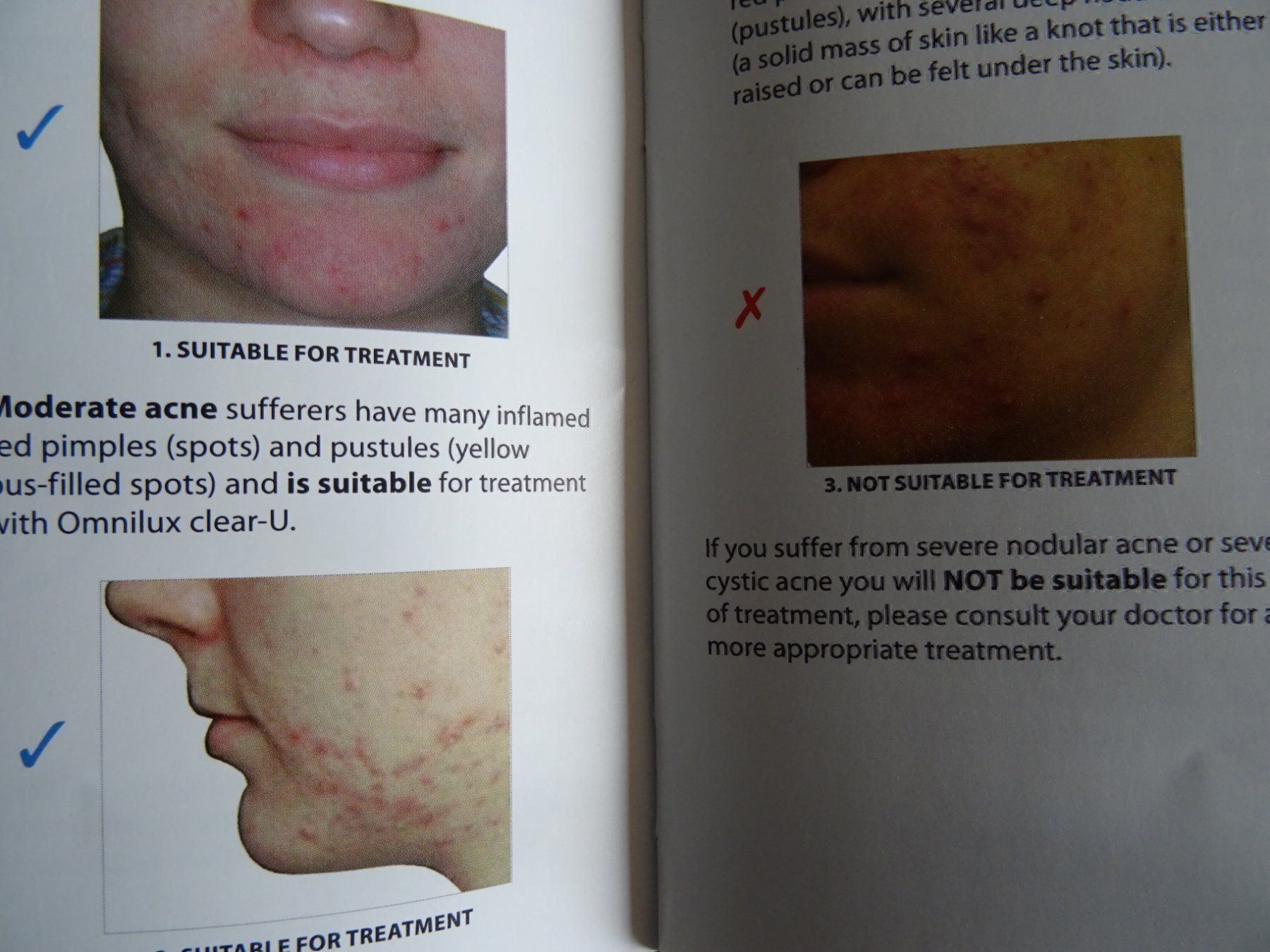 Attrezzature mediche: Akne Licht Behandlung / Therapie – Usato da Nottwil venduto da Frontal 2