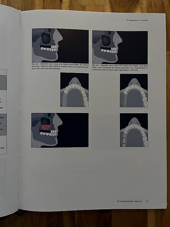 Libri: ITI Treatment Guide Volume 5 English Sinus Floor Elevation – Usato da Neuhausen am Rheinfall venduto da ram_kw6n 1