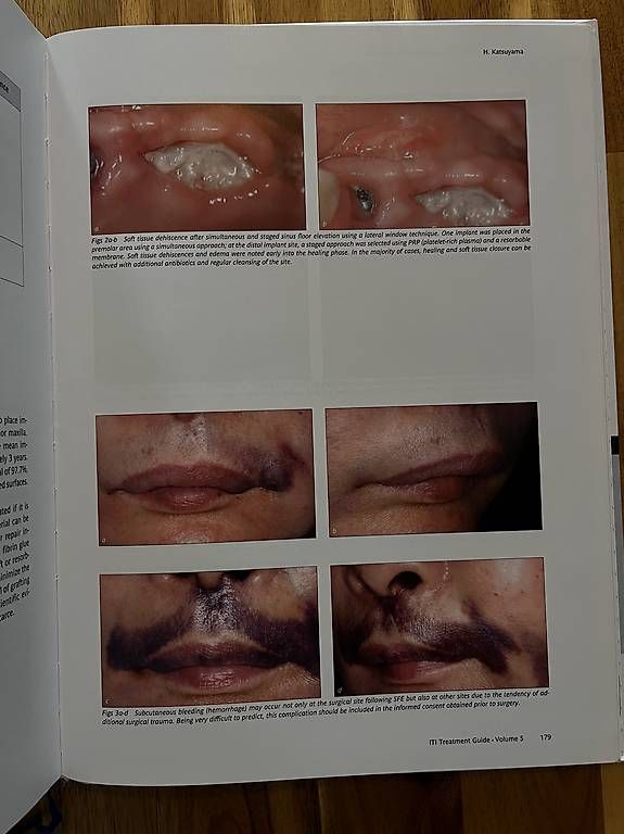 Libri: ITI Treatment Guide Volume 5 English Sinus Floor Elevation – Usato da Neuhausen am Rheinfall venduto da ram_kw6n 4
