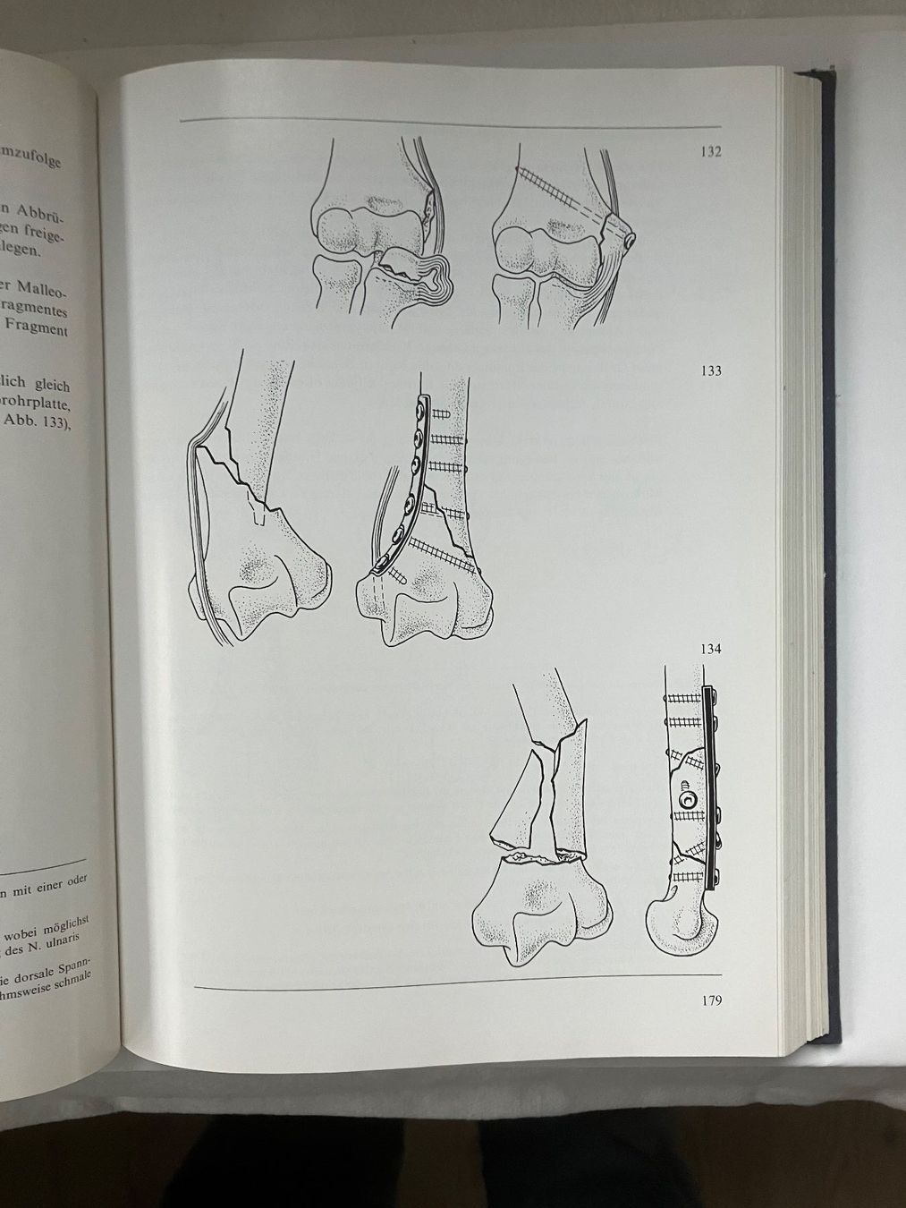 Libri: Manual der Osteosynthese Mülle.Allgöwer.SchneiderWillenegger – Usato da ZUERICH venduto da Carolus1 8
