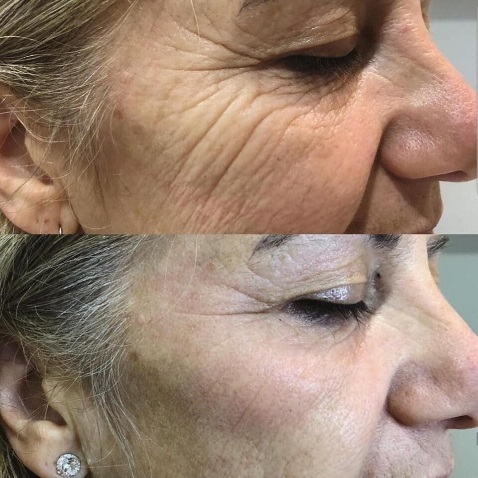 Derma Medizinische Geräte: 4D HIFU Faltenreduktion / Lifting Gerät – Neu (gemäss Beschreibung) aus Boningen von Beauty_Power_GmbH 6