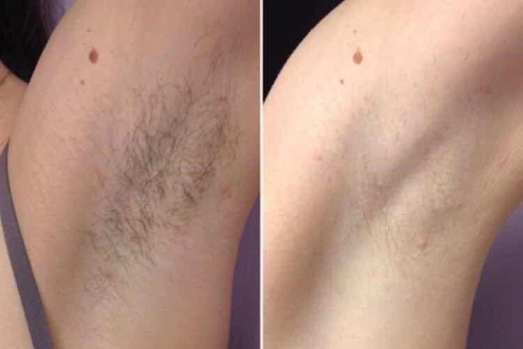 Attrezzature mediche: Diodenlaser / Diodengerät Modell Nina – Nuovo (secondo la descrizione) da Boningen venduto da Beauty_Power_GmbH 6
