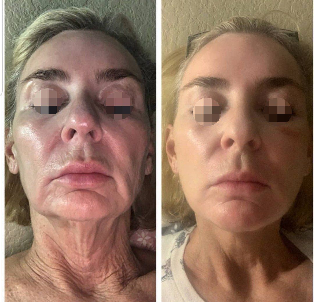 Derma Medizinische Geräte: 4D HIFU Faltenreduktion / Lifting Gerät – Neu (gemäss Beschreibung) aus Boningen von Beauty_Power_GmbH 7