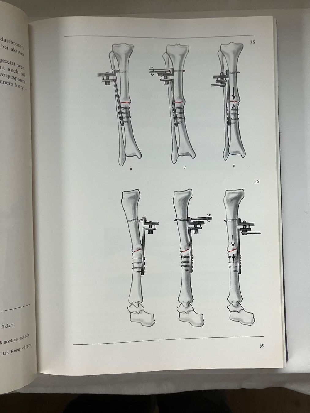 Libri: Manual der Osteosynthese Mülle.Allgöwer.SchneiderWillenegger – Usato da ZUERICH venduto da Carolus1 6