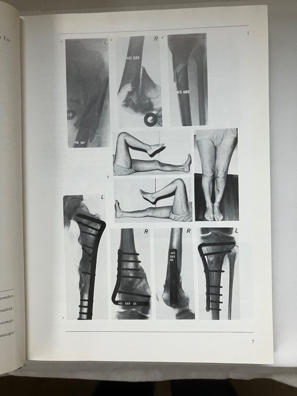 Libri: Manual der Osteosynthese Mülle.Allgöwer.SchneiderWillenegger – Usato da ZUERICH venduto da Carolus1 3