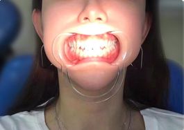 Mundwinkelhalter Für Mundöffner Dental C-Form Zahnreinig