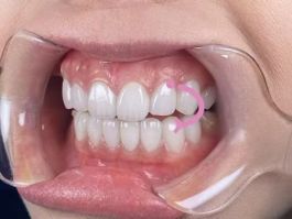 Mundöffner Mundwinkelhalter Für Dental C-Form Zahnreinig