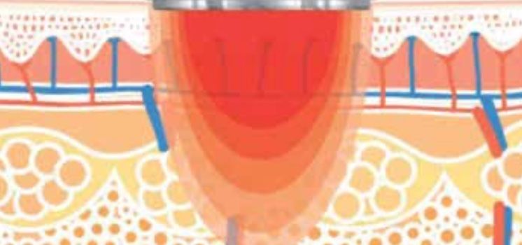 Medizinische Geräte: T-SHAPE : Système 3-en-1 Remodelage & Anti-âge – Gebraucht aus Lutry von mircon 2