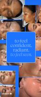 Skin Pen Microneedling Aknenarben Feine Linien und Fältchen