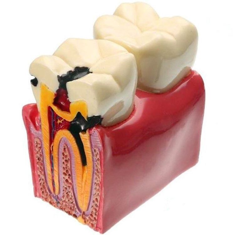 Dents avec caries : anatomie modèle 1